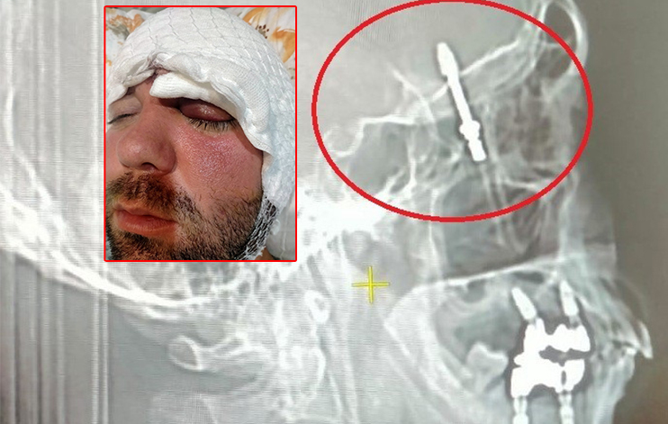 Bursa’da dişini çektirdi ölümden döndü! Bursa'da diş tedavisi için gittiği özel klinikte yaptırdığı implant işlemi,